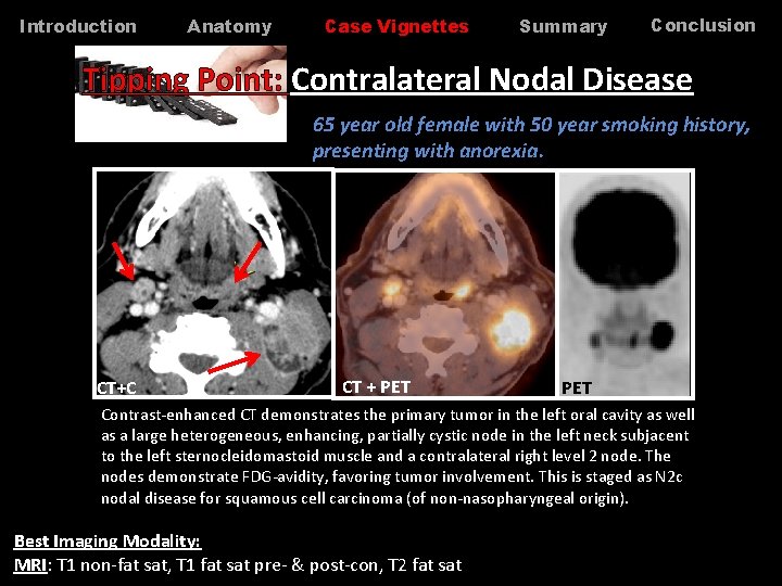 Introduction Anatomy Case Vignettes Summary Conclusion Tipping Point: Contralateral Nodal Disease 65 year old Introduction Anatomy Case Vignettes Summary Conclusion Tipping Point: Contralateral Nodal Disease 65 year old