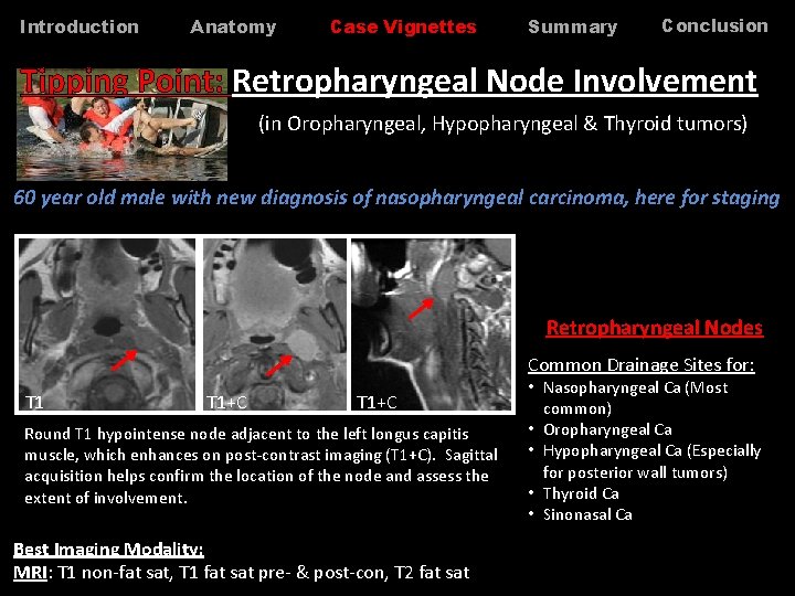 Introduction Anatomy Case Vignettes Summary Conclusion Tipping Point: Retropharyngeal Node Involvement (in Oropharyngeal, Hypopharyngeal Introduction Anatomy Case Vignettes Summary Conclusion Tipping Point: Retropharyngeal Node Involvement (in Oropharyngeal, Hypopharyngeal