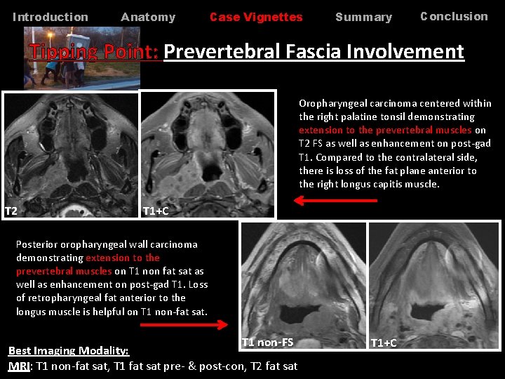 Introduction Anatomy Case Vignettes Summary Conclusion Tipping Point: Prevertebral Fascia Involvement Oropharyngeal carcinoma centered Introduction Anatomy Case Vignettes Summary Conclusion Tipping Point: Prevertebral Fascia Involvement Oropharyngeal carcinoma centered