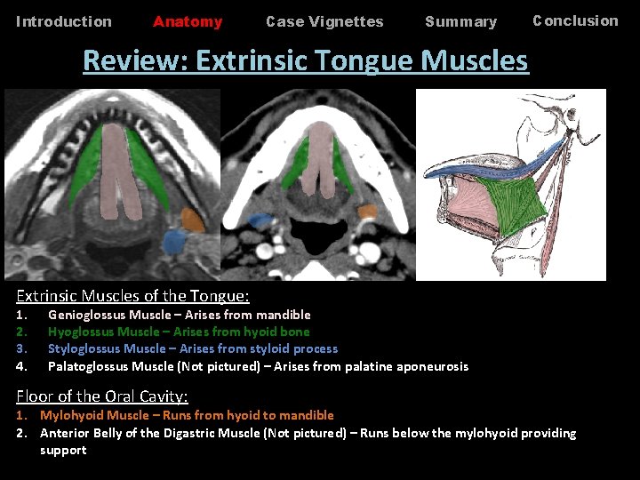 Introduction Anatomy Case Vignettes Summary Conclusion Review: Extrinsic Tongue Muscles Extrinsic Muscles of the Introduction Anatomy Case Vignettes Summary Conclusion Review: Extrinsic Tongue Muscles Extrinsic Muscles of the