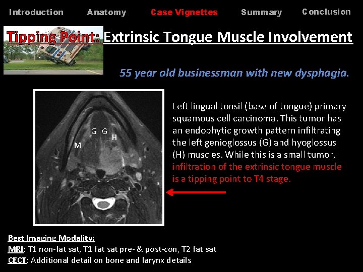 Anatomy Introduction Case Vignettes Summary Conclusion Tipping Point: Extrinsic Tongue Muscle Involvement 55 year Anatomy Introduction Case Vignettes Summary Conclusion Tipping Point: Extrinsic Tongue Muscle Involvement 55 year