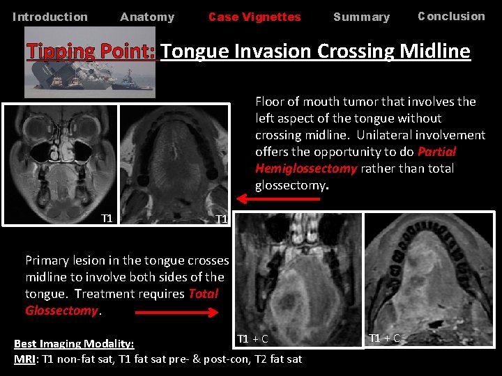 Anatomy Introduction Case Vignettes Summary Conclusion Tipping Point: Tongue Invasion Crossing Midline Floor of Anatomy Introduction Case Vignettes Summary Conclusion Tipping Point: Tongue Invasion Crossing Midline Floor of