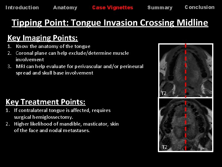 Introduction Anatomy Case Vignettes Summary Conclusion Tipping Point: Tongue Invasion Crossing Midline Key Imaging Introduction Anatomy Case Vignettes Summary Conclusion Tipping Point: Tongue Invasion Crossing Midline Key Imaging