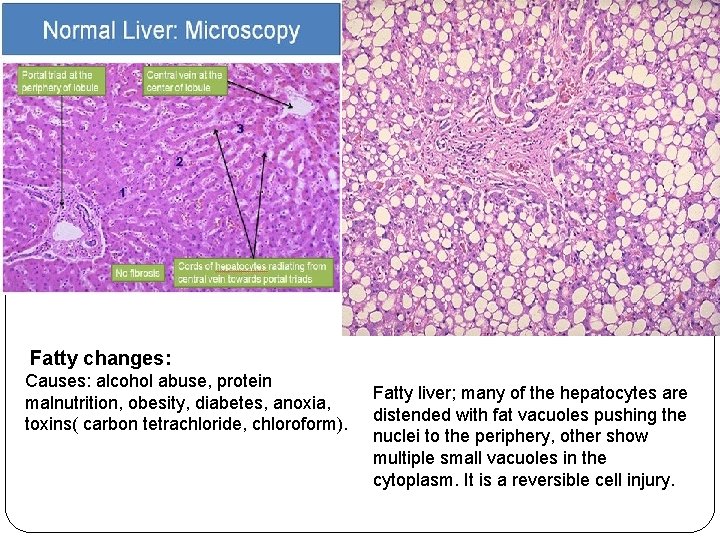 Fatty changes: Causes: alcohol abuse, protein malnutrition, obesity, diabetes, anoxia, toxins( carbon tetrachloride, chloroform). Fatty changes: Causes: alcohol abuse, protein malnutrition, obesity, diabetes, anoxia, toxins( carbon tetrachloride, chloroform).