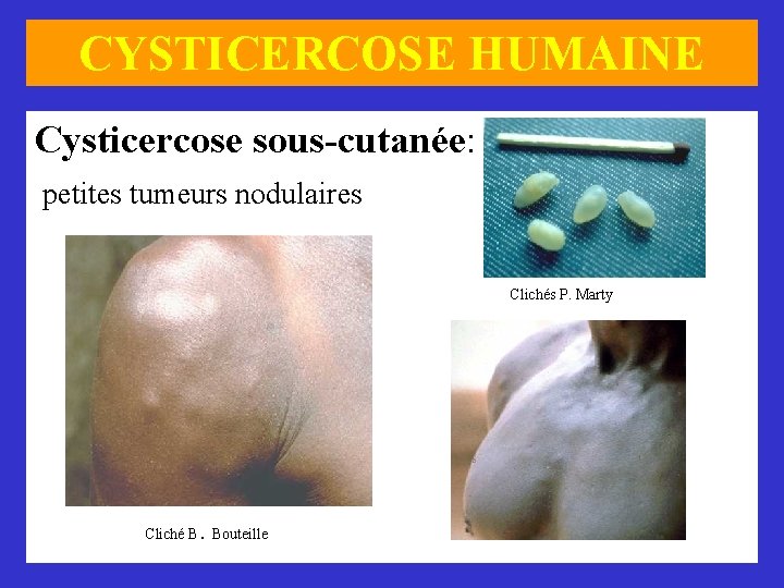CYSTICERCOSE HUMAINE Cysticercose sous-cutanée: petites tumeurs nodulaires Clichés P. Marty . Cliché B Bouteille