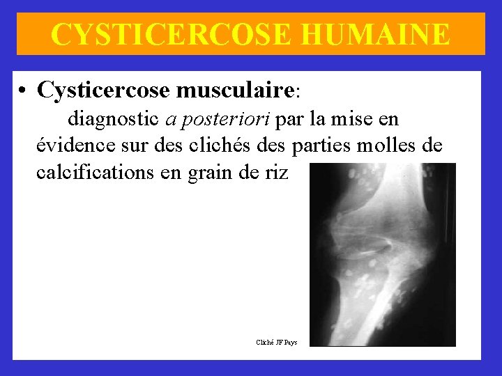 CYSTICERCOSE HUMAINE • Cysticercose musculaire: diagnostic a posteriori par la mise en évidence sur