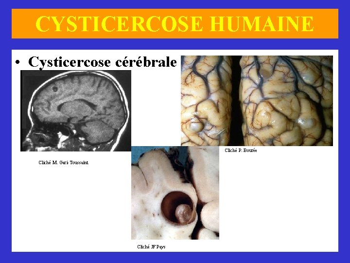 CYSTICERCOSE HUMAINE • Cysticercose cérébrale Cliché P. Bourée Cliché M. Gari-Toussaint Cliché JF Pays