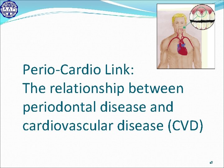 Perio-Cardio Link: The relationship between periodontal disease and cardiovascular disease (CVD) 18 
