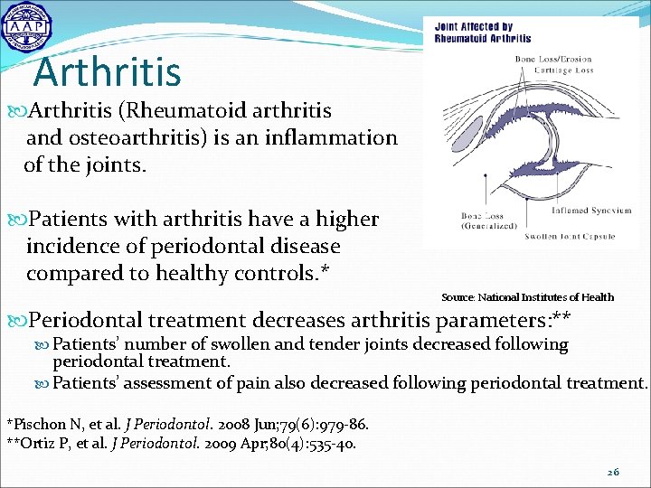 Arthritis (Rheumatoid arthritis and osteoarthritis) is an inflammation of the joints. Patients with arthritis