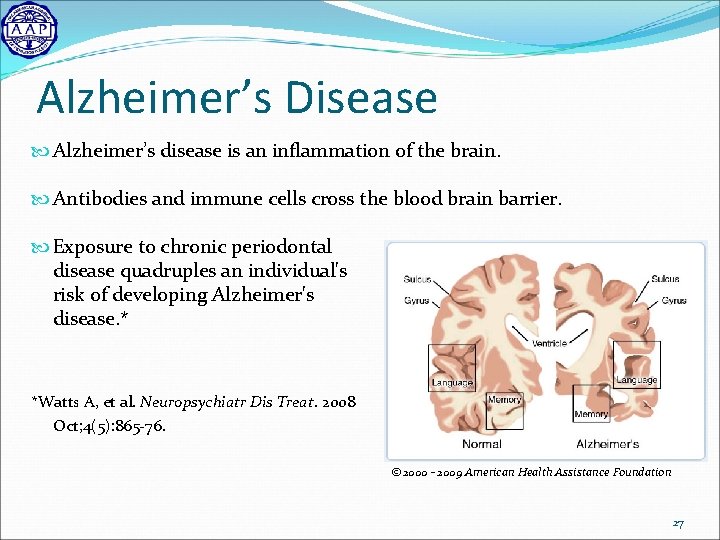 Alzheimer’s Disease Alzheimer’s disease is an inflammation of the brain. Antibodies and immune cells