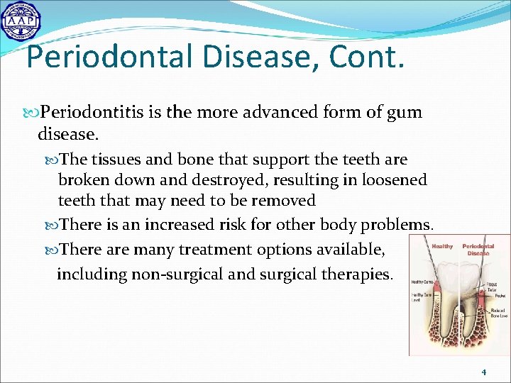 Periodontal Disease, Cont. Periodontitis is the more advanced form of gum disease. The tissues