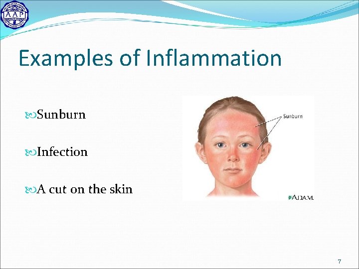 Examples of Inflammation Sunburn Infection A cut on the skin 7 