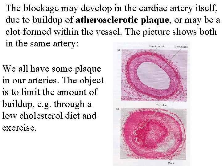 The blockage may develop in the cardiac artery itself, due to buildup of atherosclerotic