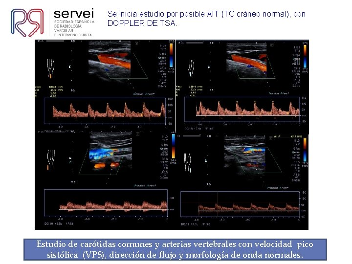 Se inicia estudio por posible AIT (TC cráneo normal), con DOPPLER DE TSA. Estudio