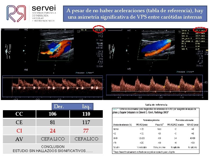 A pesar de no haber aceleraciones (tabla de referencia), hay una asimetría significativa de