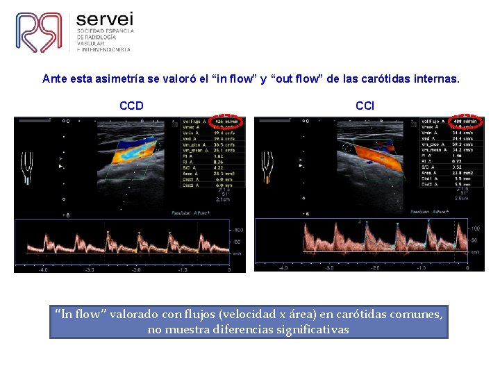 Ante esta asimetría se valoró el “in flow” y “out flow” de las carótidas