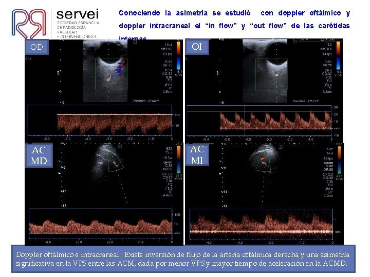 Conociendo la asimetría se estudió con doppler oftálmico y doppler intracraneal el “in flow”