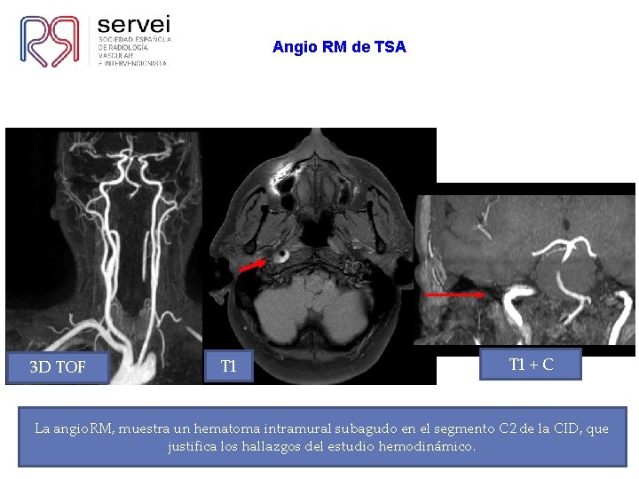 Angio RM de TSA 3 D TOF T 1 + C La angio. RM,