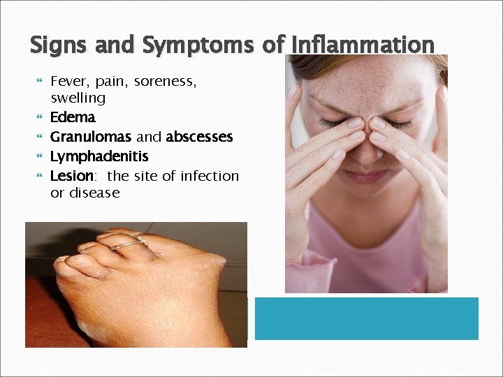 Signs and Symptoms of Inflammation Fever, pain, soreness, swelling Edema Granulomas and abscesses Lymphadenitis