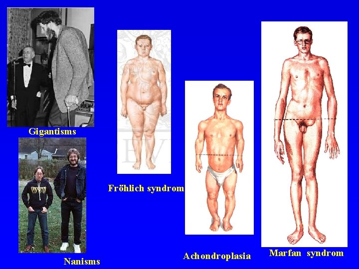Gigantisms Fröhlich syndrom Nanisms Achondroplasia Marfan syndrom 
