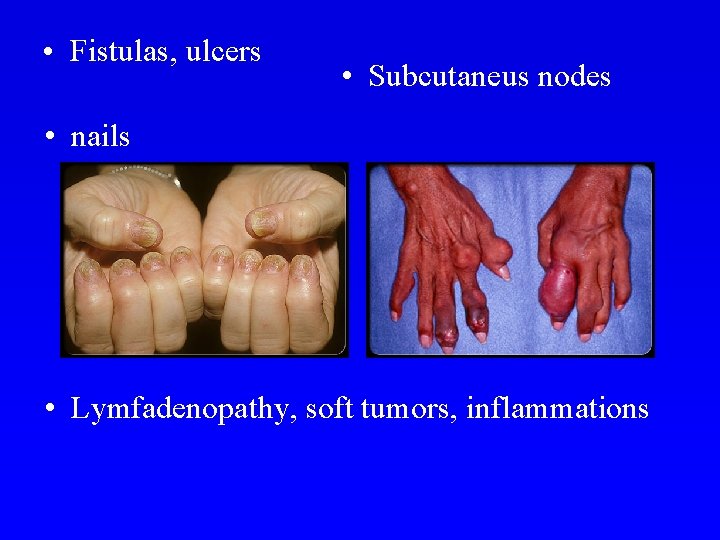  • Fistulas, ulcers • Subcutaneus nodes • nails • Lymfadenopathy, soft tumors, inflammations