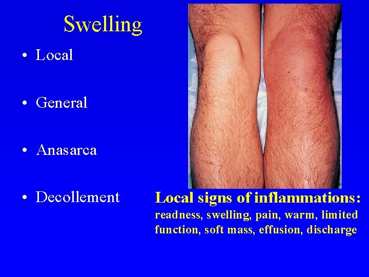 Swelling • Local • General • Anasarca • Decollement Local signs of inflammations: readness,