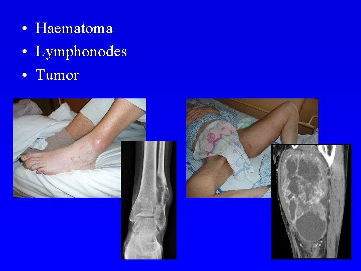  • Haematoma • Lymphonodes • Tumor 