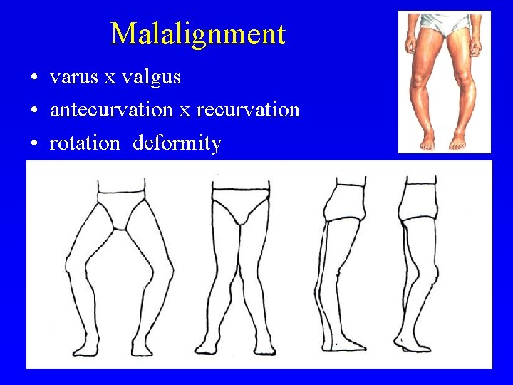 Malalignment • varus x valgus • antecurvation x recurvation • rotation deformity odchylka 