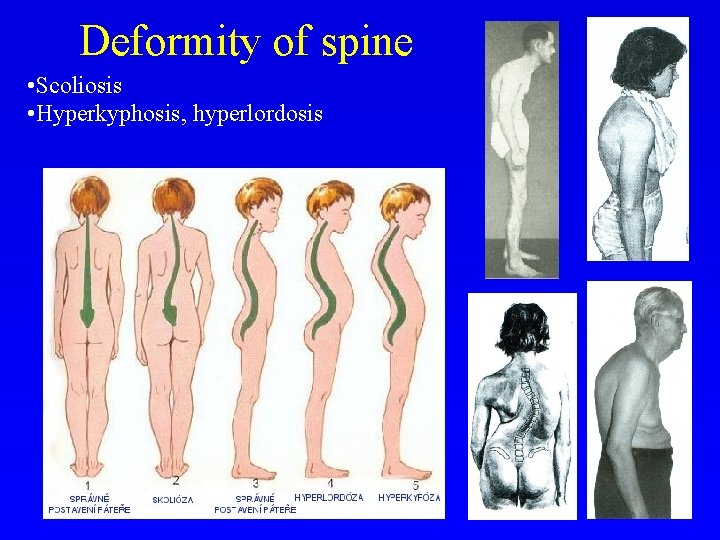 Deformity of spine • Scoliosis • Hyperkyphosis, hyperlordosis 