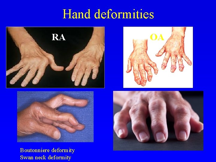 Hand deformities RA Boutonniere deformity Swan neck deformity OA 