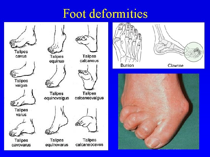 Foot deformities 