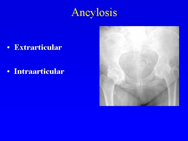 Ancylosis • Extrarticular • Intraarticular 