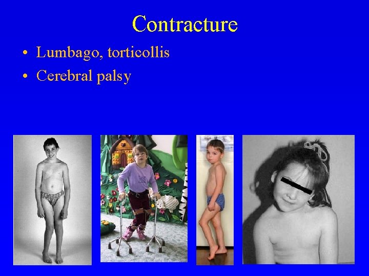 Contracture • Lumbago, torticollis • Cerebral palsy 