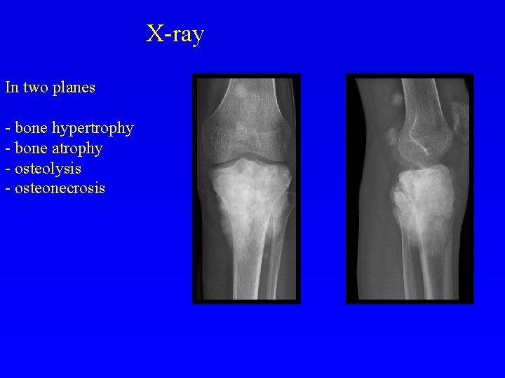 X-ray In two planes - bone hypertrophy - bone atrophy - osteolysis - osteonecrosis