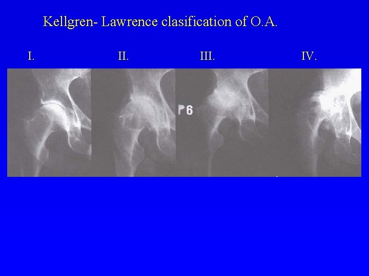 Kellgren- Lawrence clasification of O. A. I. III. IV. 