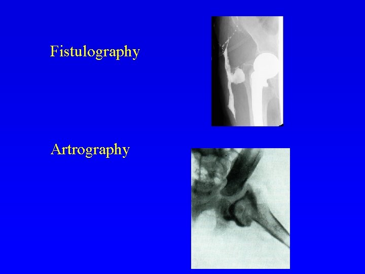 Fistulography Artrography 