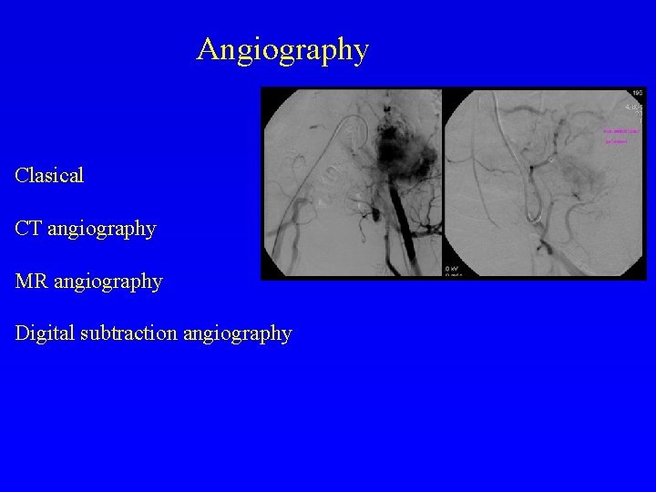 Angiography Clasical CT angiography MR angiography Digital subtraction angiography 