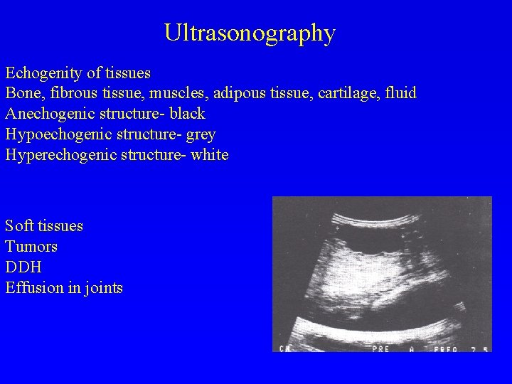 Ultrasonography Echogenity of tissues Bone, fibrous tissue, muscles, adipous tissue, cartilage, fluid Anechogenic structure-