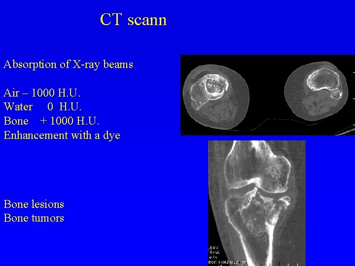 CT scann Absorption of X-ray beams Air – 1000 H. U. Water 0 H.