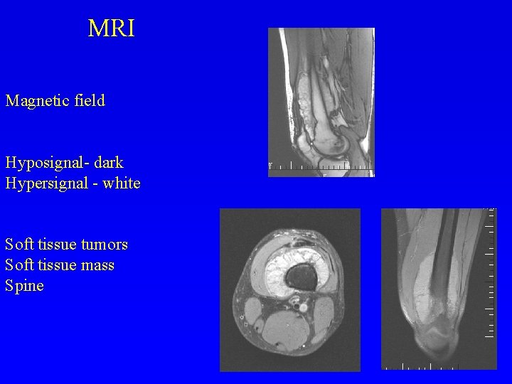 MRI Magnetic field Hyposignal- dark Hypersignal - white Soft tissue tumors Soft tissue mass