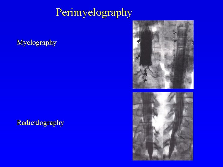 Perimyelography Myelography Radiculography 