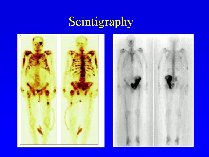 Scintigraphy 