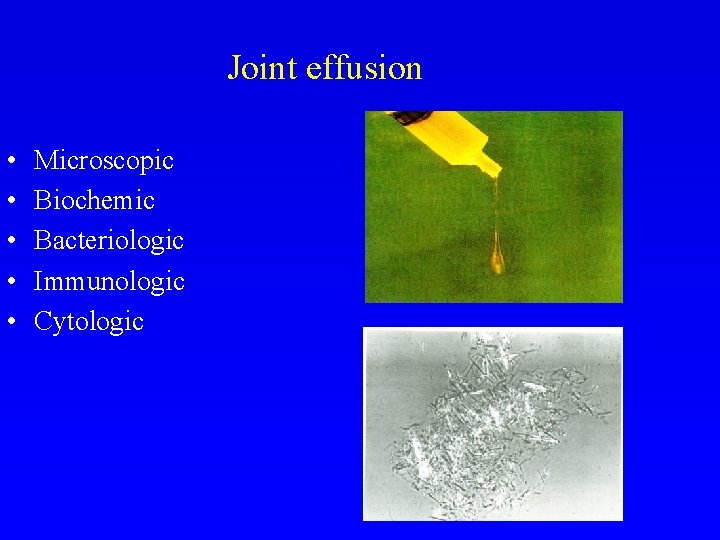 Joint effusion • • • Microscopic Biochemic Bacteriologic Immunologic Cytologic 