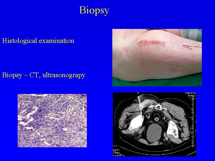 Biopsy Histological examination Biopsy – CT, ultrasonograpy 
