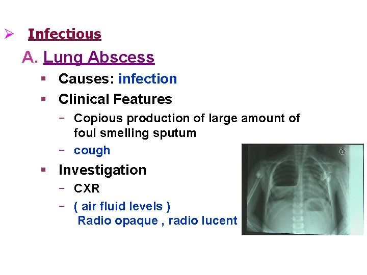 Ø Infectious A. Lung Abscess § Causes: infection § Clinical Features ‒ Copious production