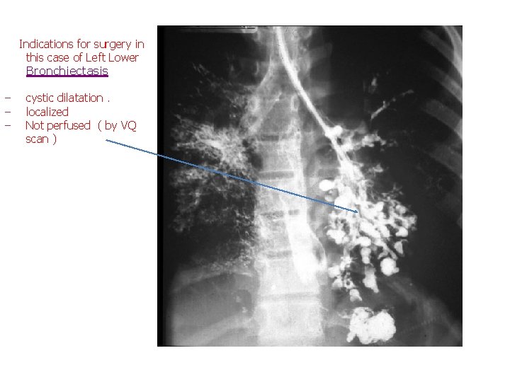 Indications for surgery in this case of Left Lower Bronchiectasis ‒ ‒ ‒ cystic Indications for surgery in this case of Left Lower Bronchiectasis ‒ ‒ ‒ cystic