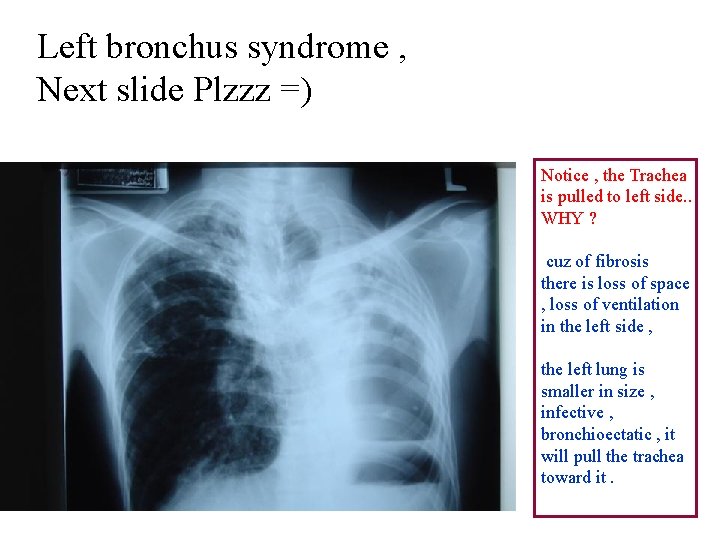 Left bronchus syndrome , Next slide Plzzz =) Notice , the Trachea is pulled