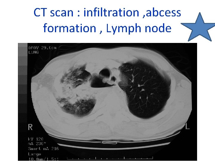 CT scan : infiltration , abcess formation , Lymph node 