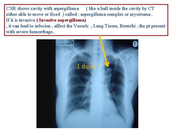 CXR shows cavity with aspergilloma ( like a ball inside the cavity by CT