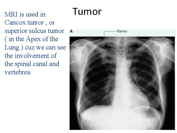 MRI is used in Cancox tumor , or superior sulcus tumor ( in the MRI is used in Cancox tumor , or superior sulcus tumor ( in the